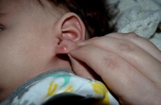 Ce trebuie să faceți dacă apare o forfotă în spatele urechii?