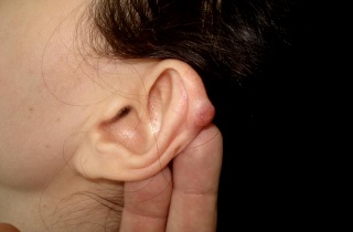pierderea în greutate bile în spatele urechilor)